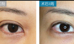 双眼皮手术后遗症，全面解析与视频资源汇总