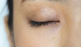 双眼皮手术后遗症，全面解析与预防措施