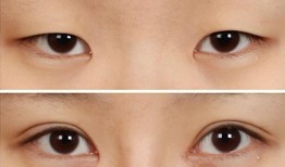双眼皮手术后的潜在后遗症及应对策略