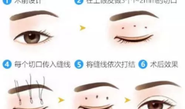 双眼皮手术后的常见后遗症及其应对策略