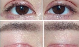 双眼皮手术后的后遗症应对策略