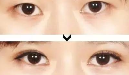 双眼皮手术，潜在后遗症及其预防