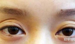 双眼皮手术后遗症，全面解析与预防措施