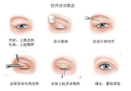 双眼皮手术的潜在副作用及其预防措施
