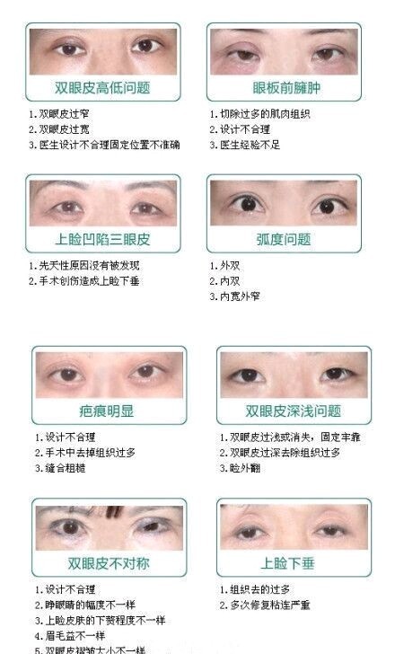 双眼皮手术的潜在副作用及其预防措施