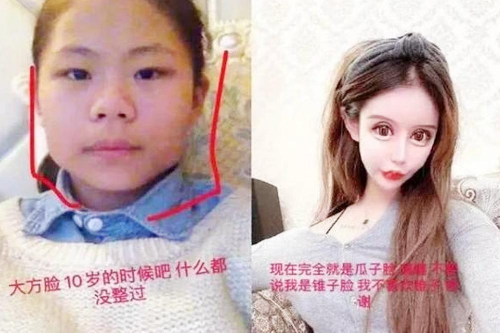 双眼皮手术的潜在危害及其预防措施