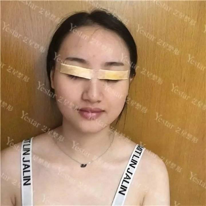 做双眼皮手术，身体影响与术后护理