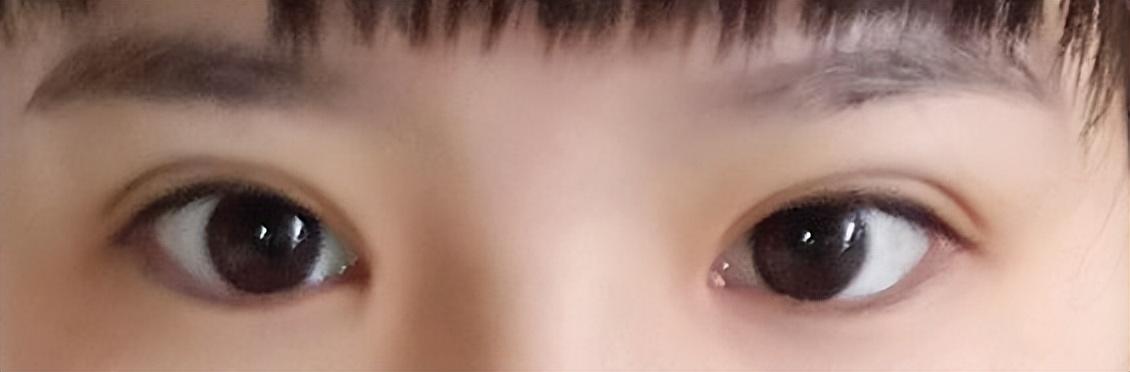 做双眼皮手术，身体影响与术后护理