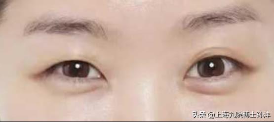 做双眼皮手术，身体影响与术后护理