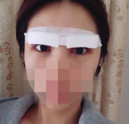 做双眼皮手术，后果、风险与恢复过程