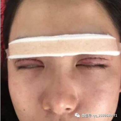 双眼皮手术后遗症，视频讲解与专业分析