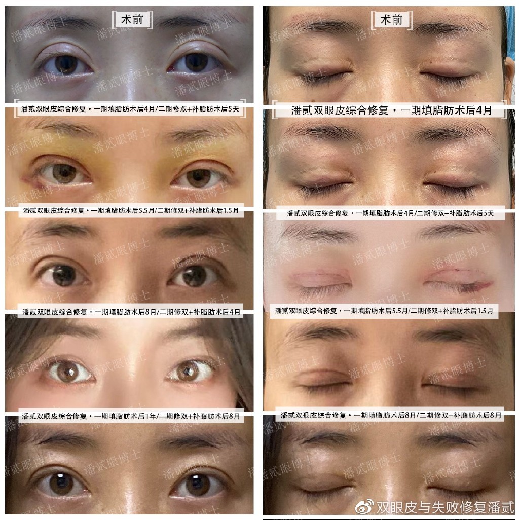双眼皮手术后遗症，视频讲解与专业分析