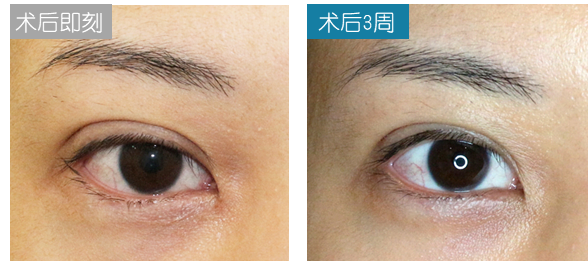 双眼皮手术后遗症，全面解析与视频资源汇总