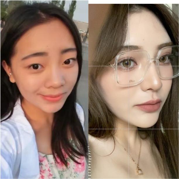 双眼皮手术恢复过程全记录，视频解析与详细指南