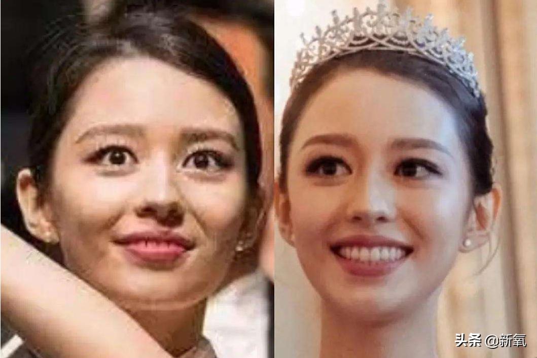 双眼皮手术后的效果，美丽蜕变与恢复过程