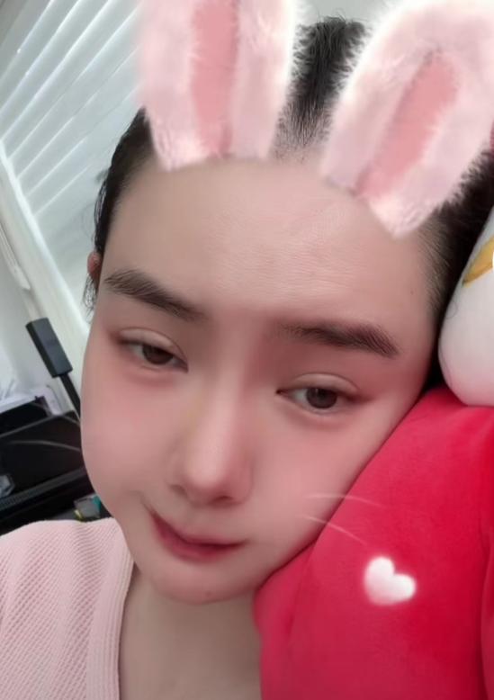 双眼皮手术后的潜在后遗症及其预防措施