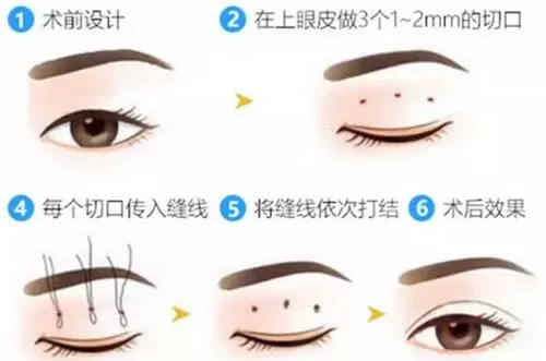 双眼皮手术后的常见后遗症及其应对策略