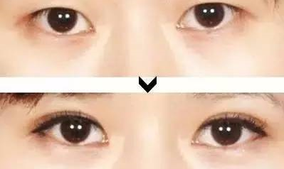 双眼皮手术，潜在后遗症及其预防
