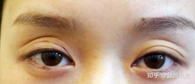 双眼皮手术后遗症，全面解析与预防措施