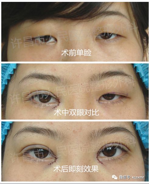 双眼皮手术后的后遗症，了解风险与预防措施