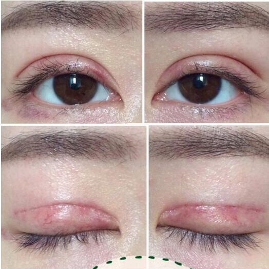 双眼皮手术后的后遗症应对策略